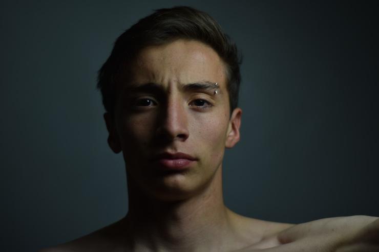 imperfecciones en aplicacion de toxina botulinica